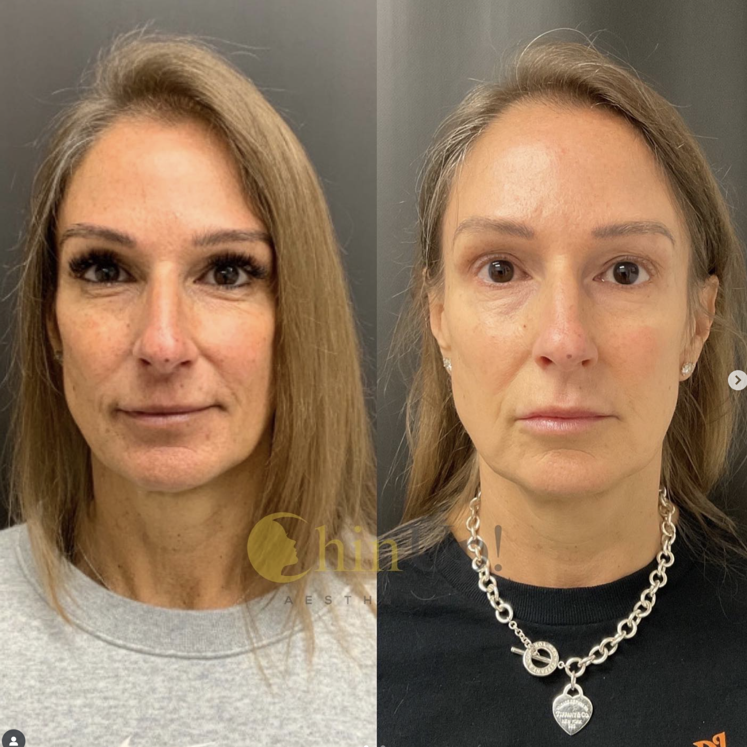Is there anything better than this natural result that will just continue to improve with time?! Sculptra is a powerful product that contains Poly-L-Lactic Acid, which is a potent collagen stimulator that helps to restore fullness to the face and soften wrinkles and folds. This results in a more youthful, balanced and softer appearance. The best part is that these results gradually occur and continue to improve over the course of 12 months. This patient was treated with 2 vials and it is clear she has significant improvement in her overall facial volume and fat pads which has resulted in such a beautiful youthful appearance. Book today to see if you are a good candidate for this treatment!